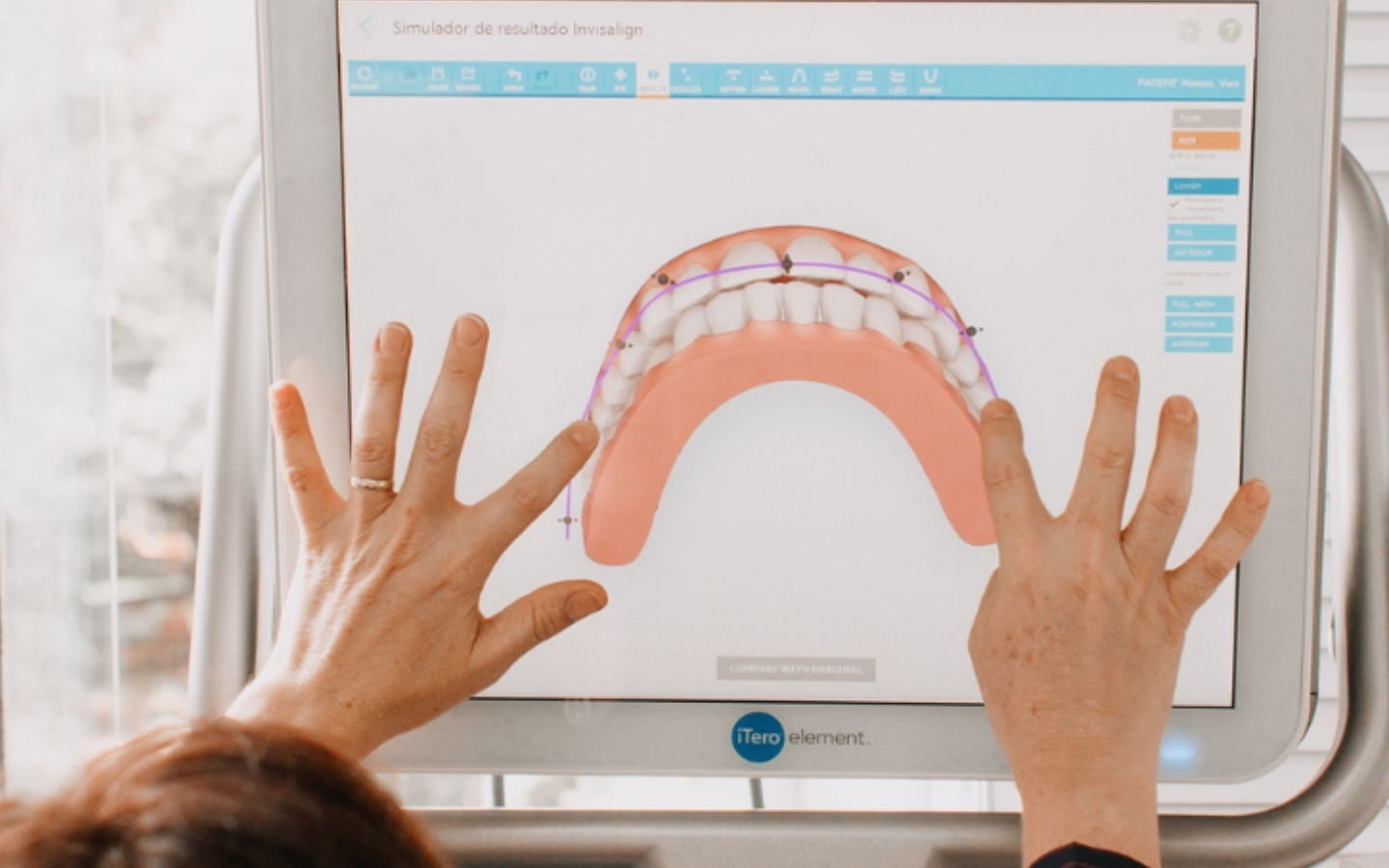 Simulação com Scanner Itero para Alinhadores Transparentes